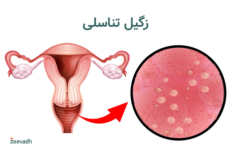 زگیل تناسلی، یک بیماری جنسی شایع است که علائم ظاهری آن در ناحیه تناسلی یا مقعد به چشم می‌خورد.